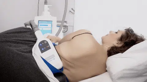 deroulement coolsculpting