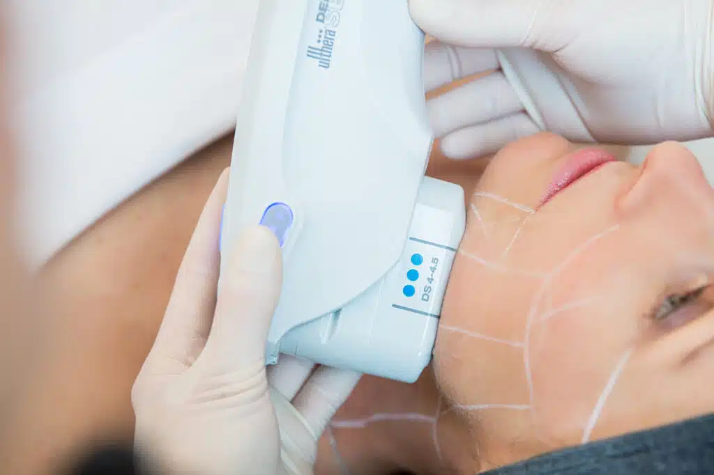 Ulthera: what are the advantages? | Blogue | Dermapure