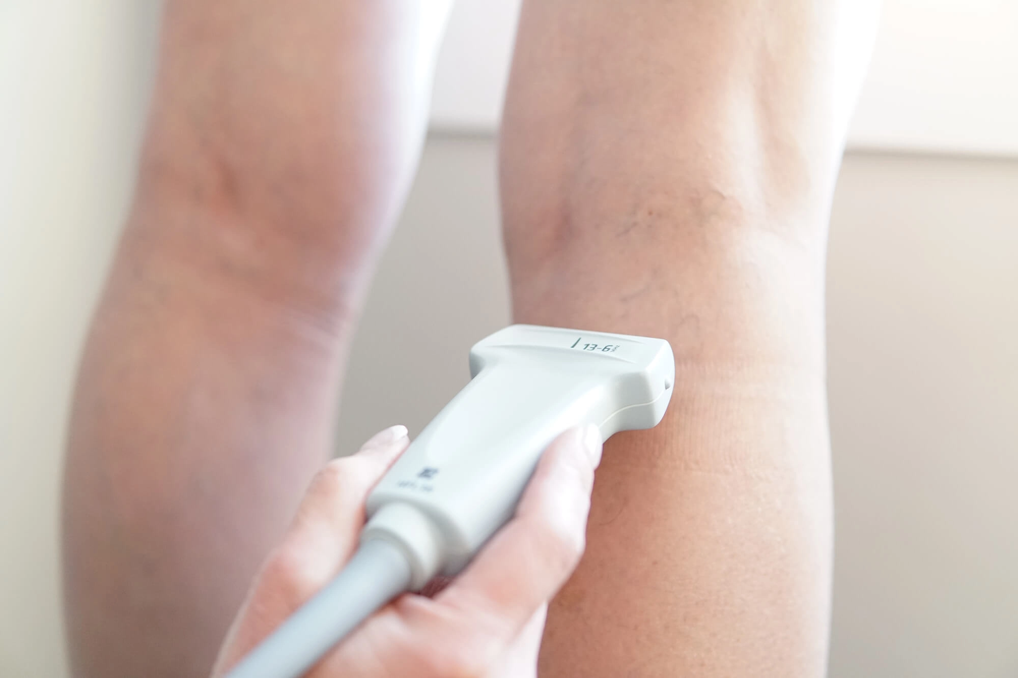 laser endoveineux deroulement