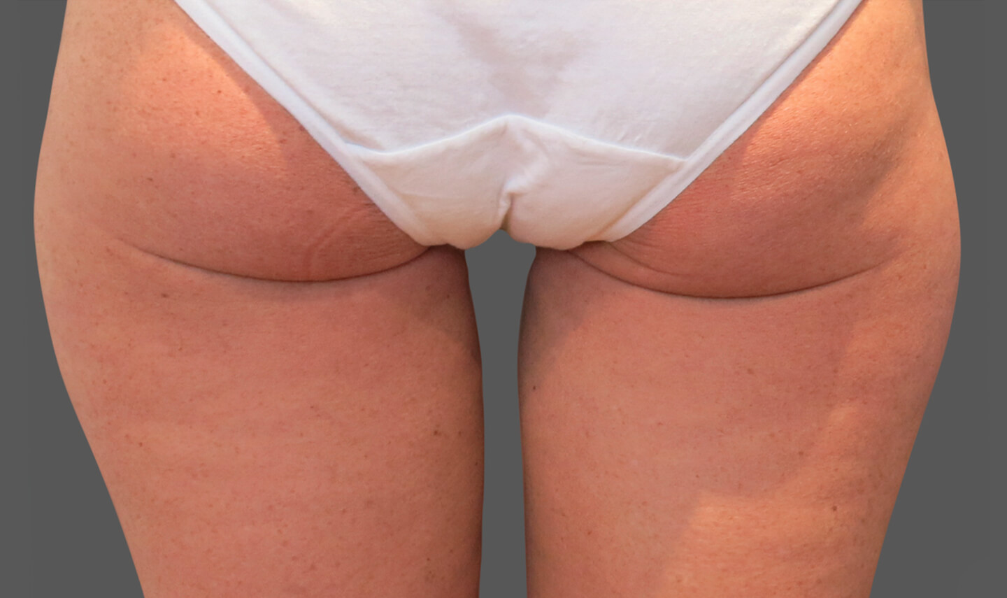 CoolSculpting résultats aprés