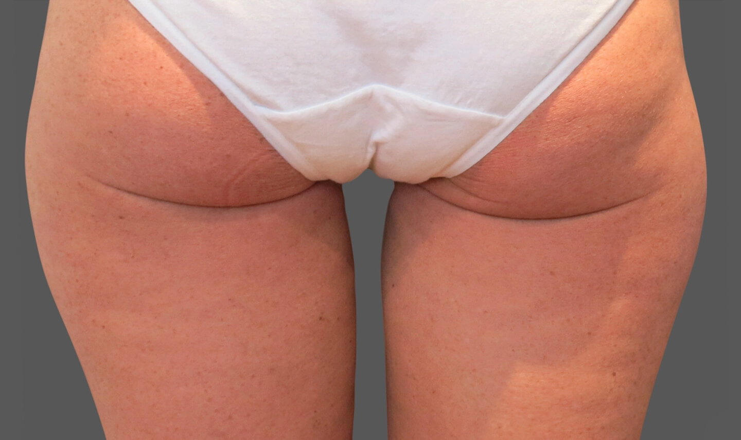 CoolSculpting résultats aprés