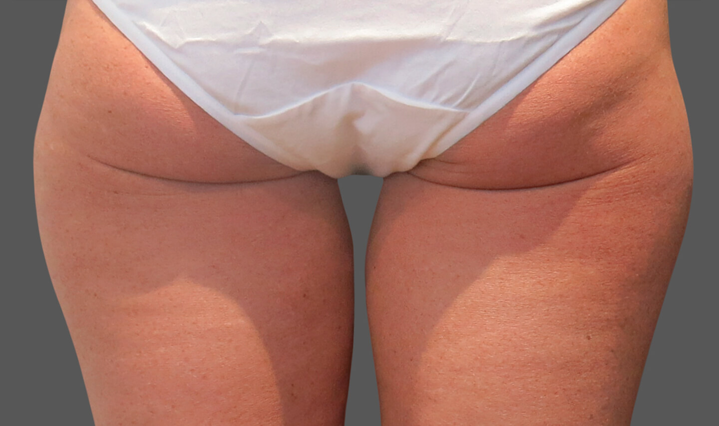 CoolSculpting avant