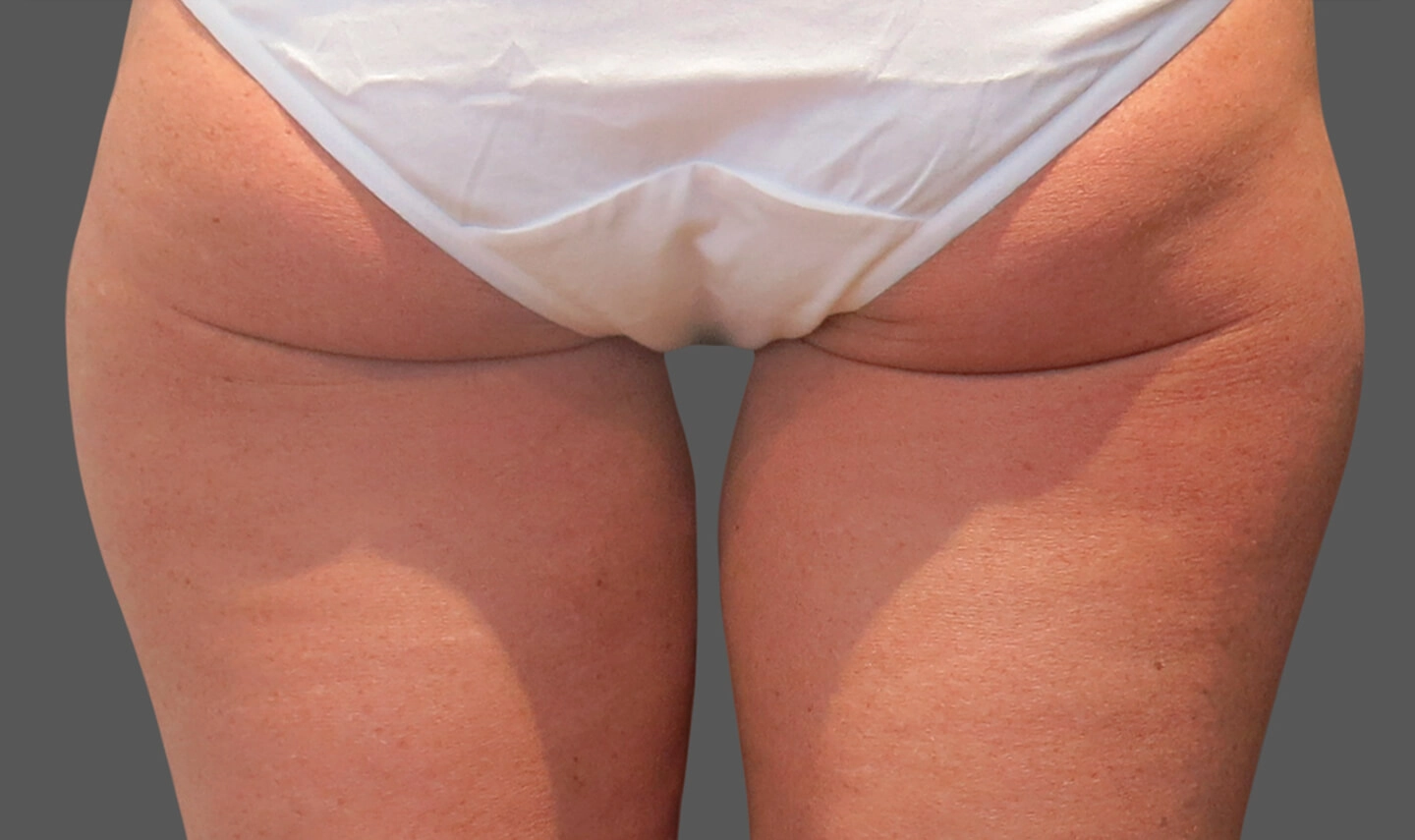 CoolSculpting avant