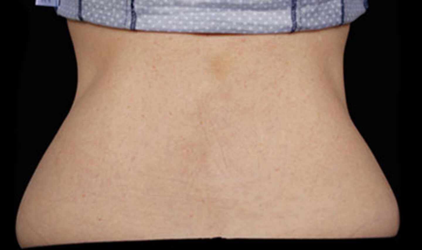 CoolSculpting résultats aprés