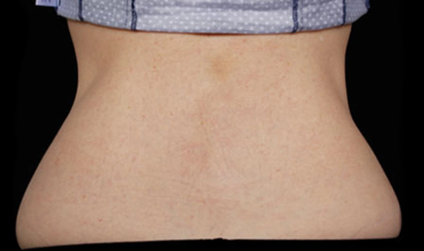 CoolSculpting résultats aprés