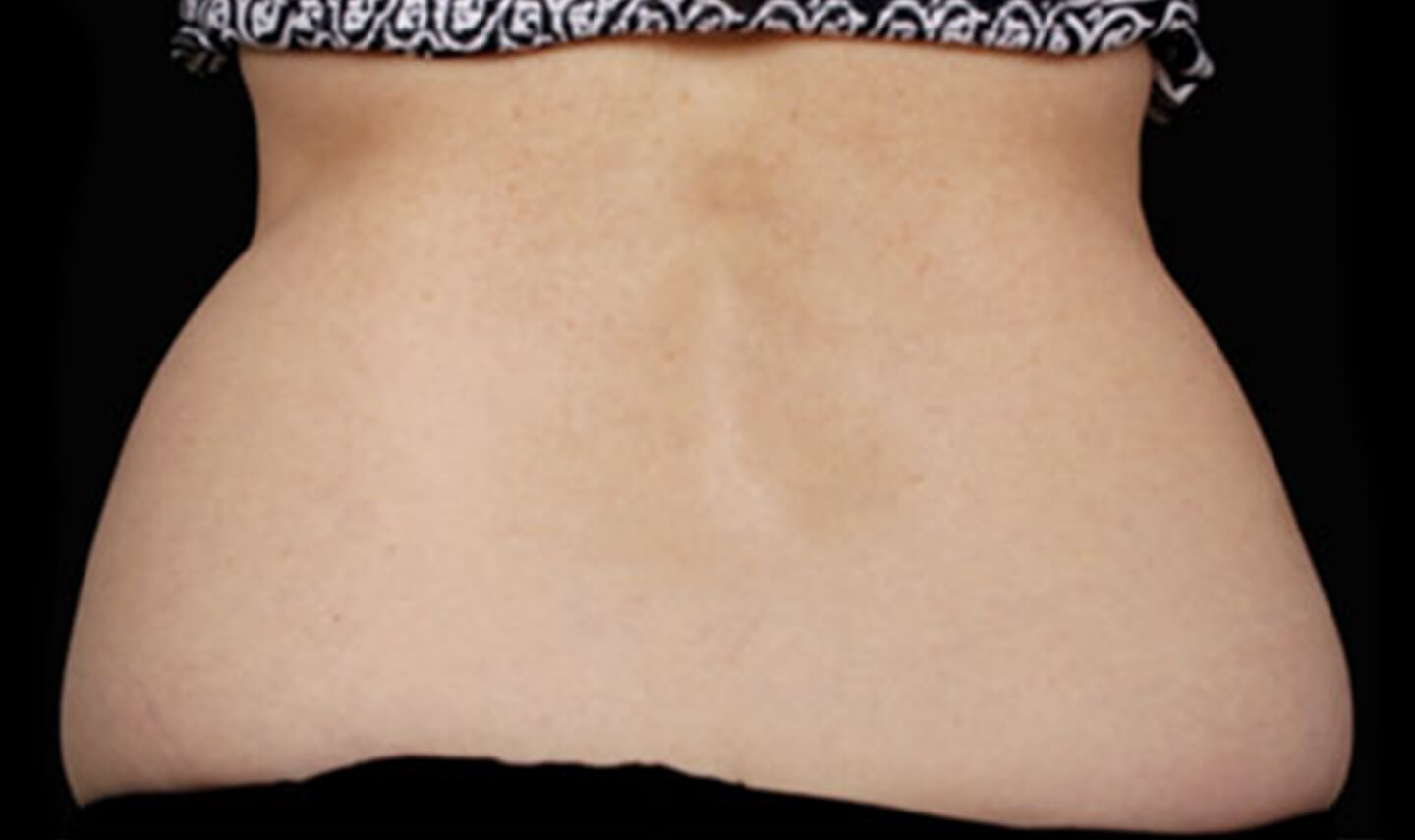 CoolSculpting avant