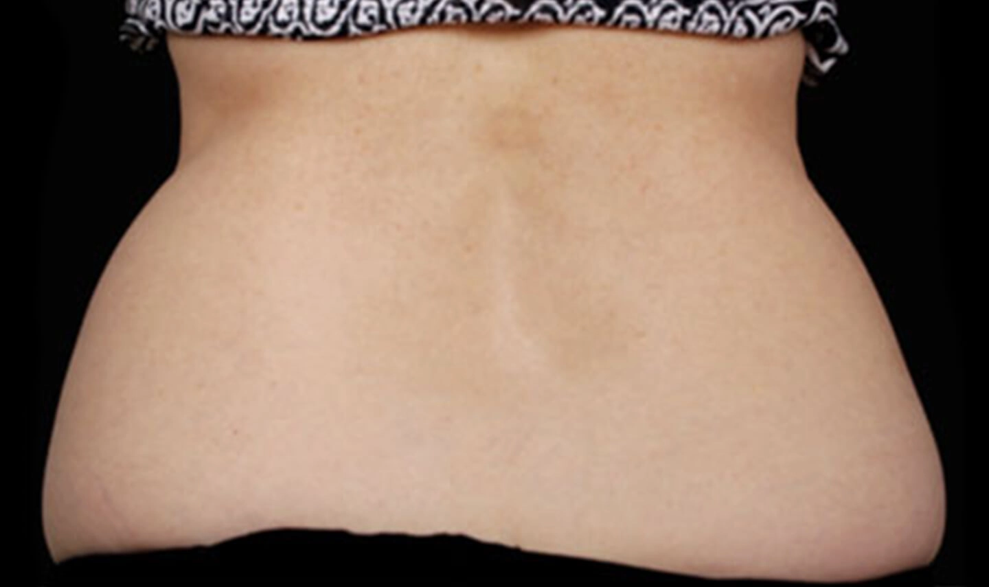 CoolSculpting avant