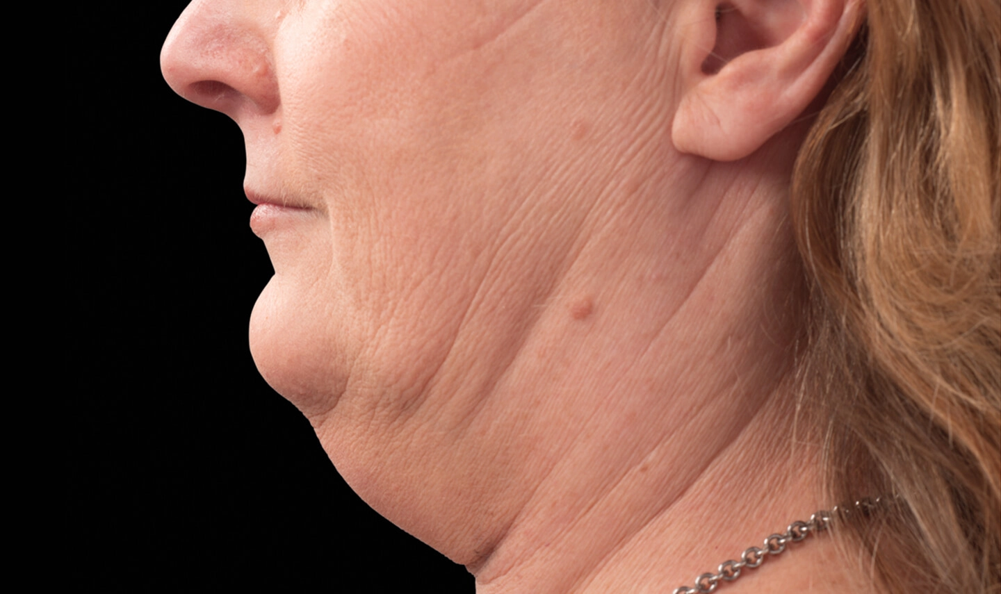CoolSculpting avant