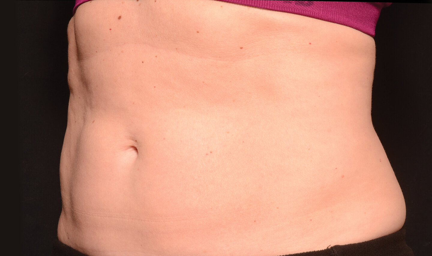 CoolSculpting résultats aprés