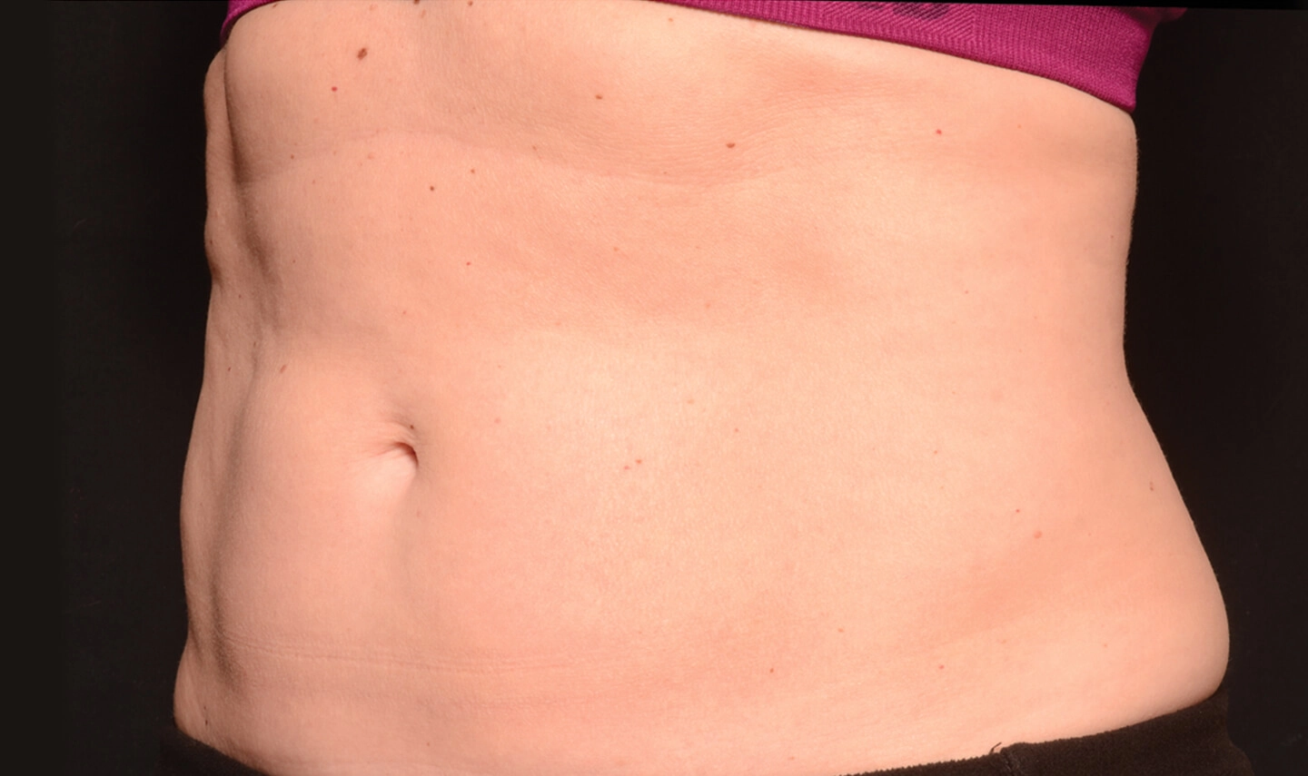 CoolSculpting résultats aprés