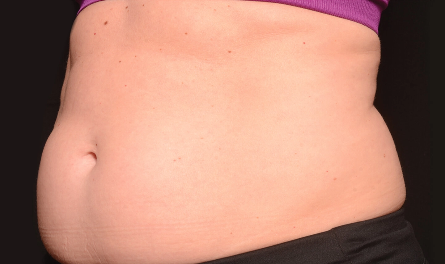 CoolSculpting avant