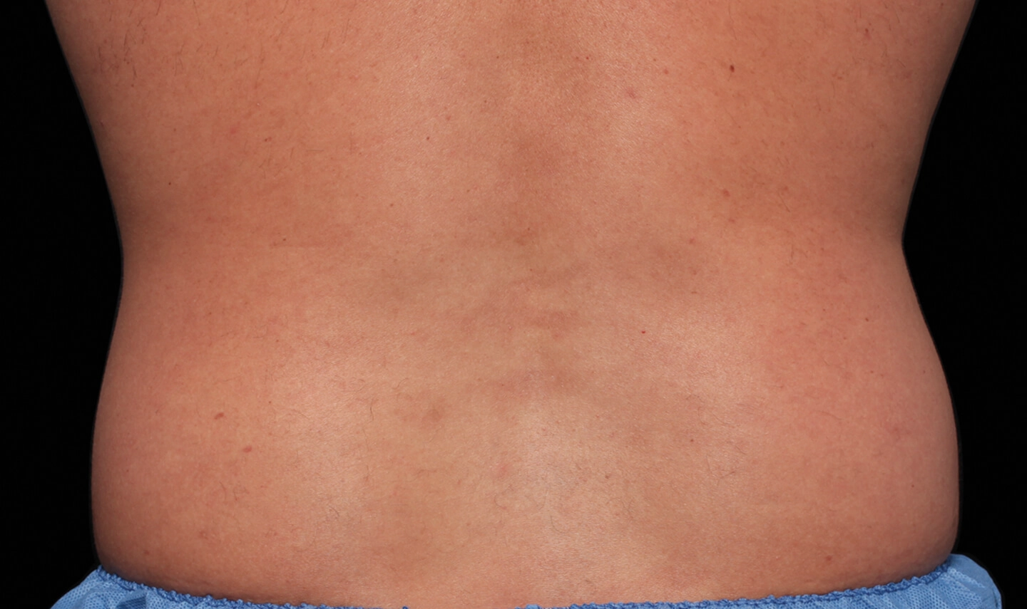 CoolSculpting avant