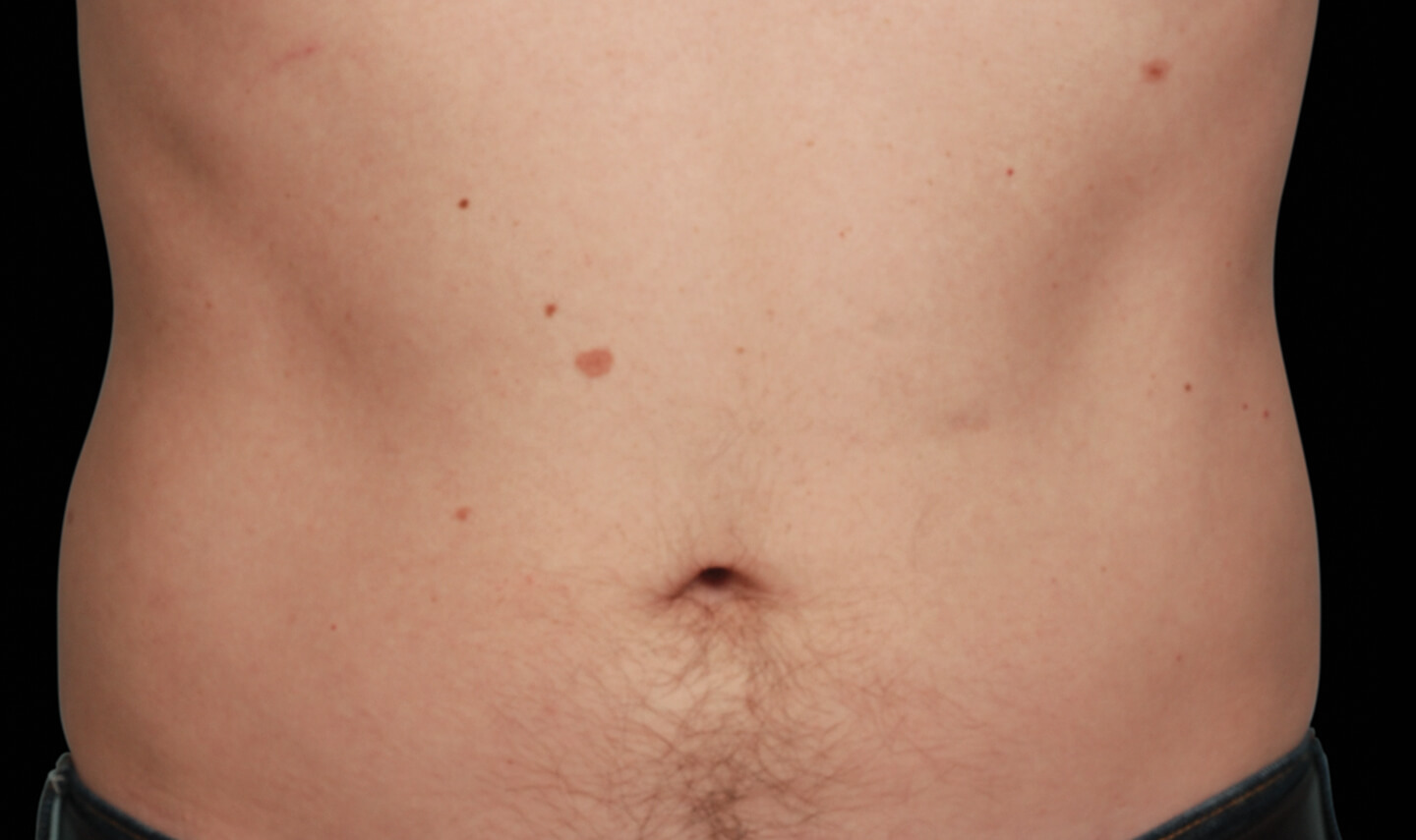 CoolSculpting résultats aprés