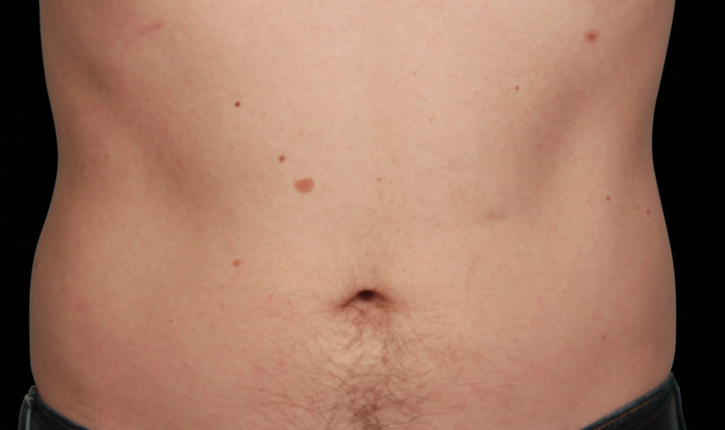 CoolSculpting résultats aprés
