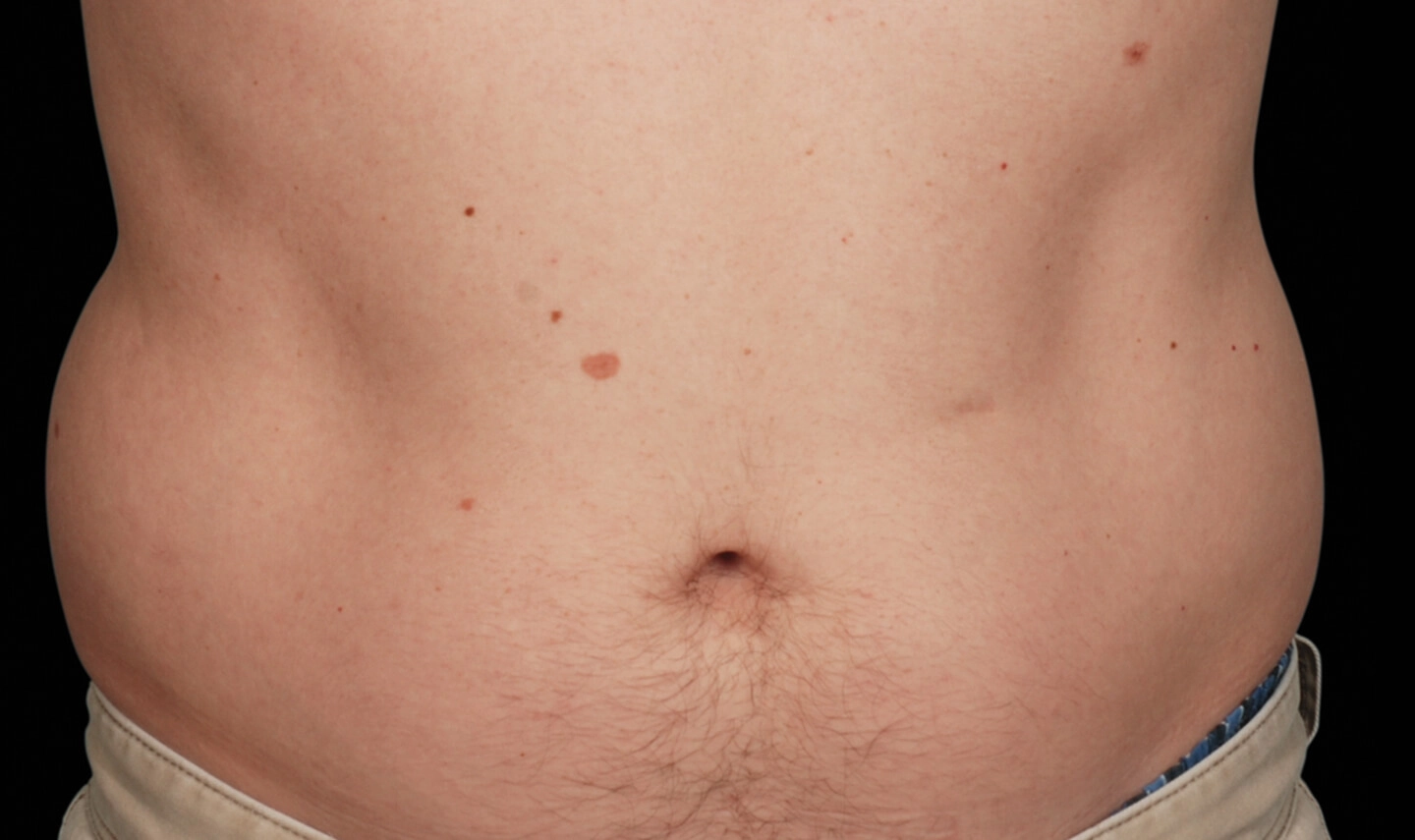 CoolSculpting avant