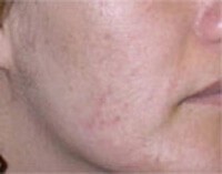 acne apres 2