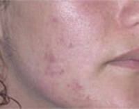 acne avant 2