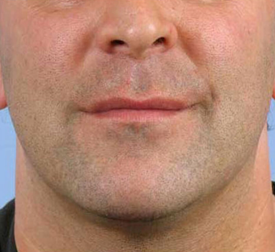 Visage d'un homme après un soin de thermage