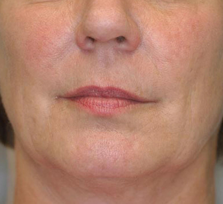 Visage de face après un soin de thermage