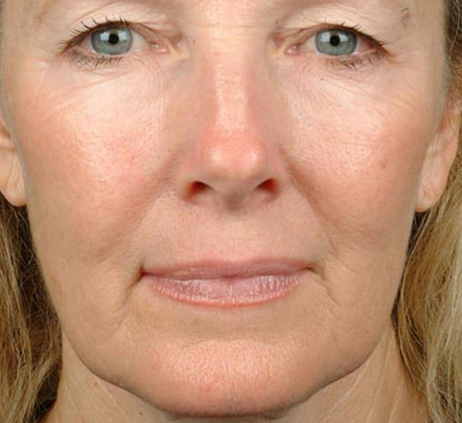 Visage de face après un soin de thermage