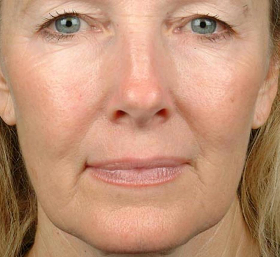 Visage de face après un soin de thermage