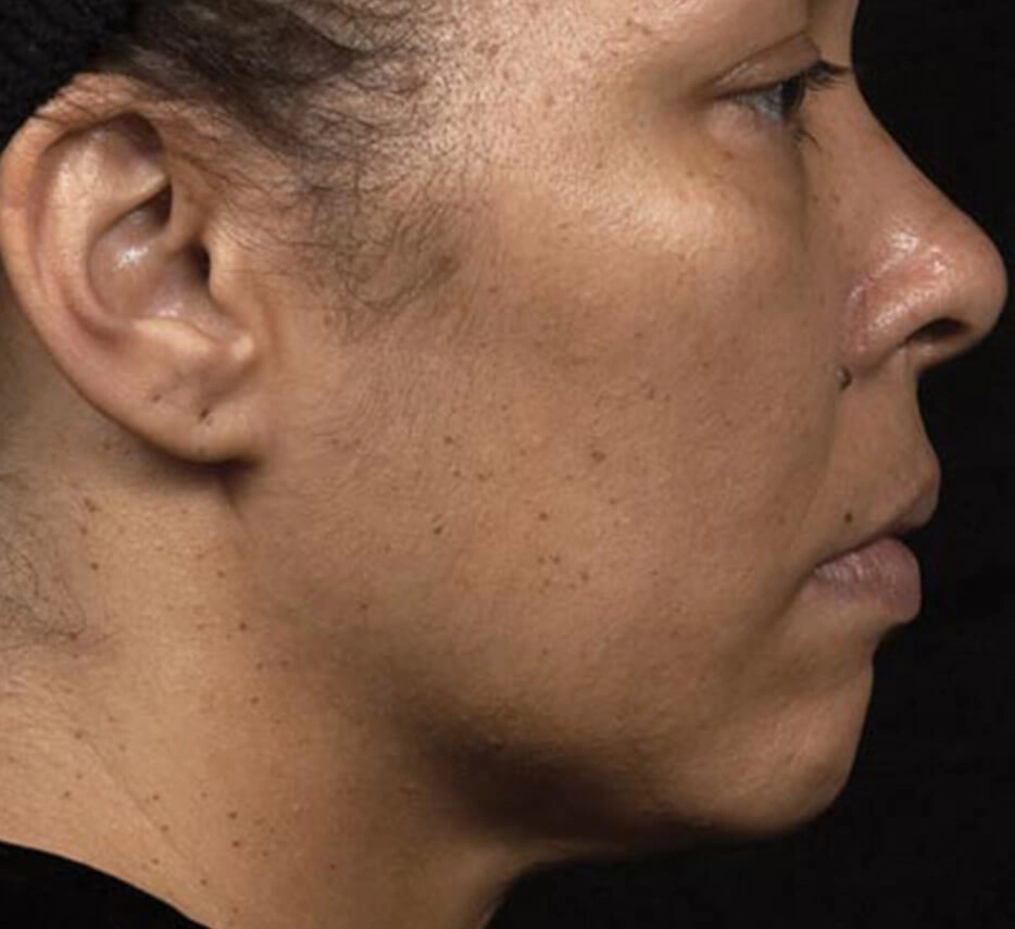 Visage de profil après un soin de thermage
