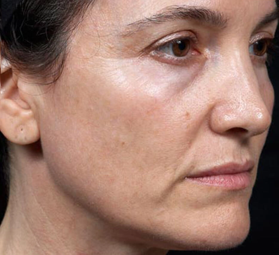 Visage après un soin de thermage