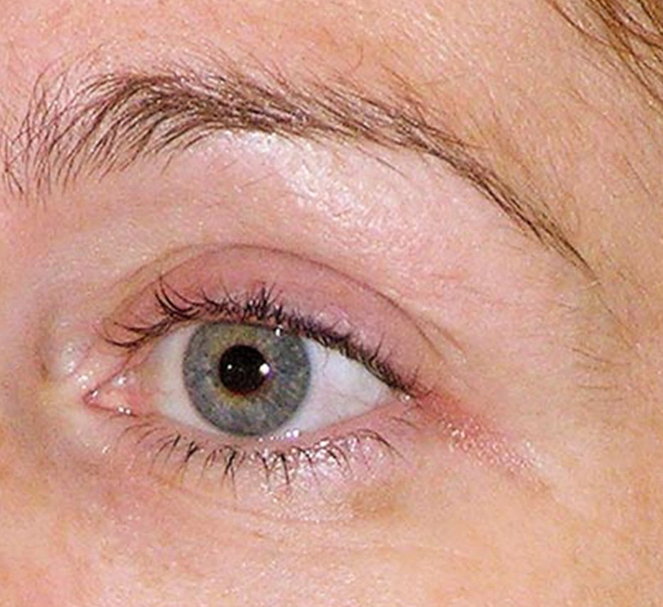 Yeux après un soin de thermage