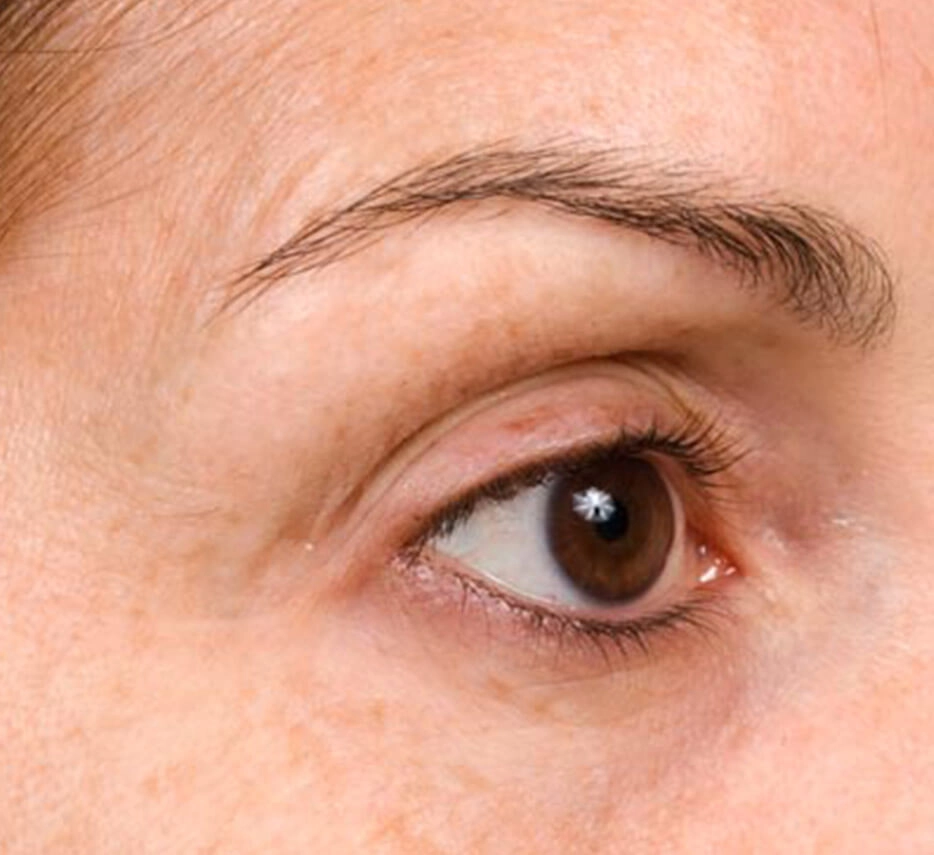 Yeux après un soin de thermage