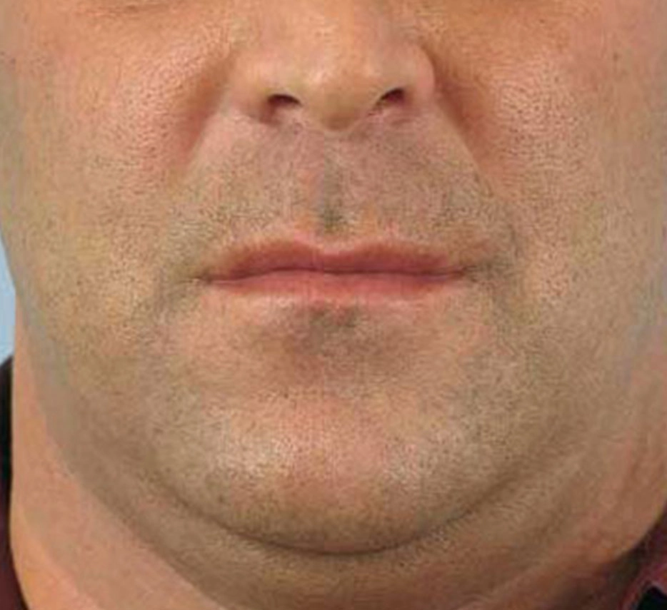 Visage d'homme de face avant un soin de thermage