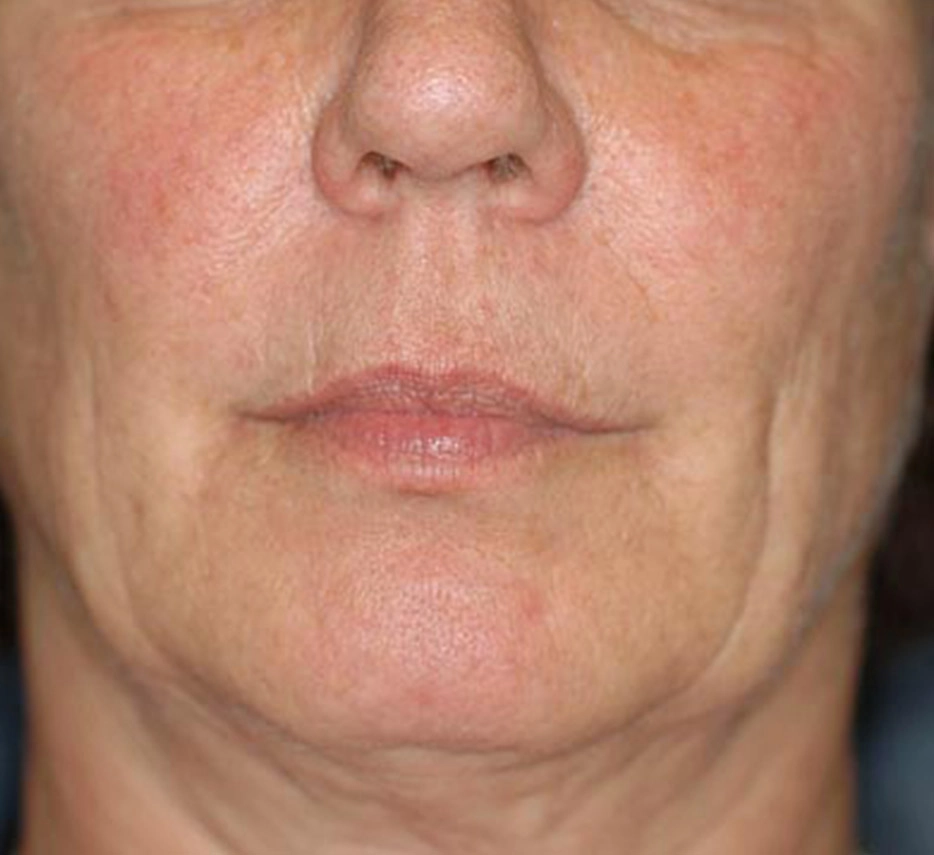 Visage de femme de face après un soin de thermage