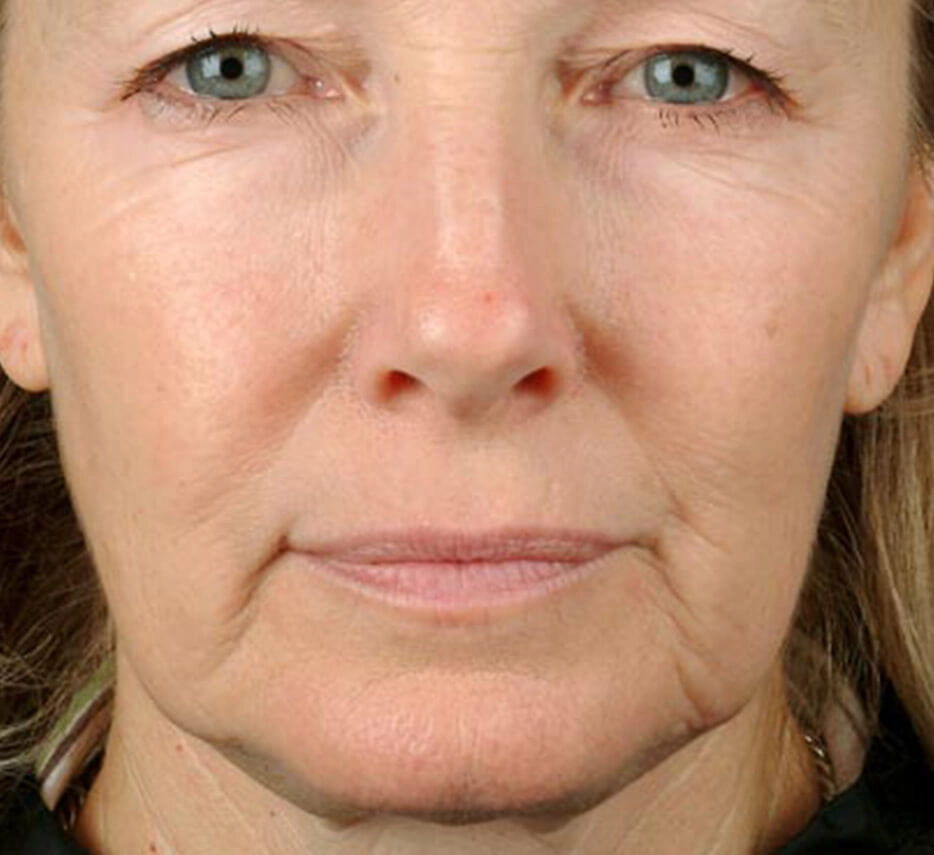 Visage de femme de face avant un soin de thermage