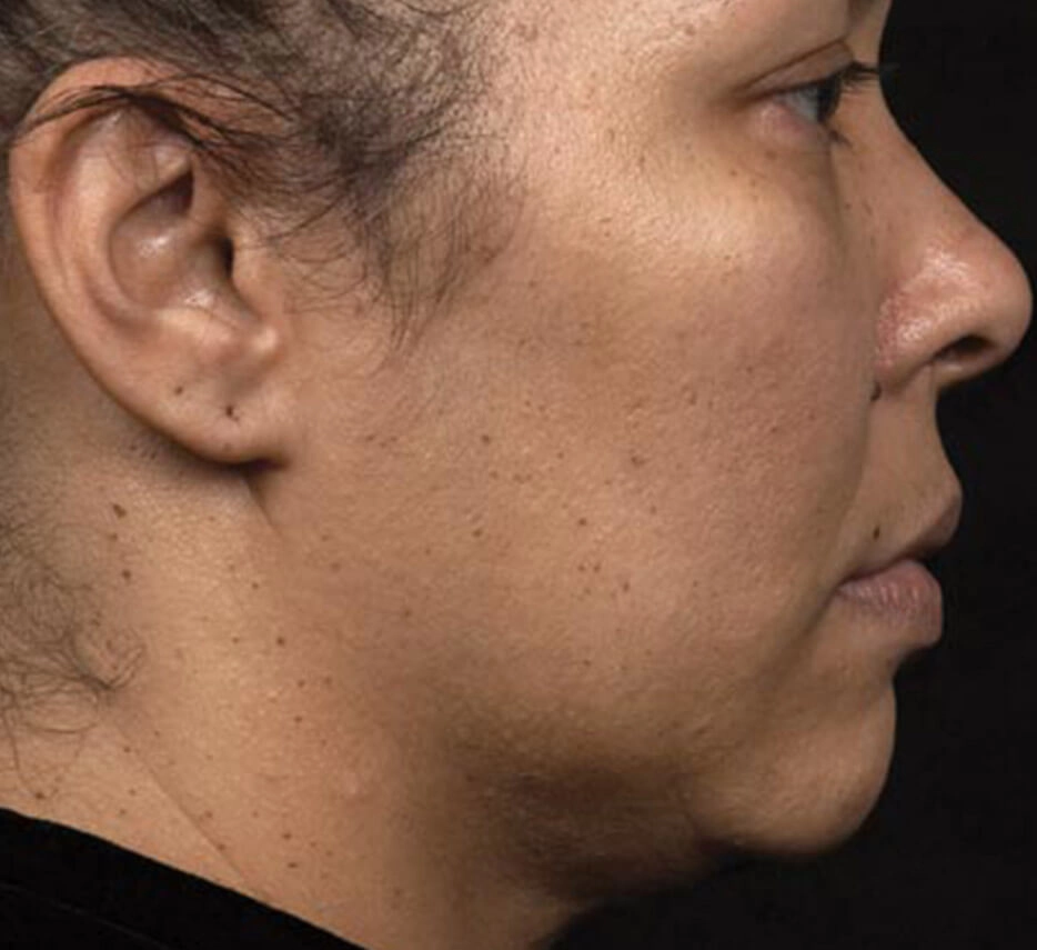 Visage de femme de profil avant un soin de thermage