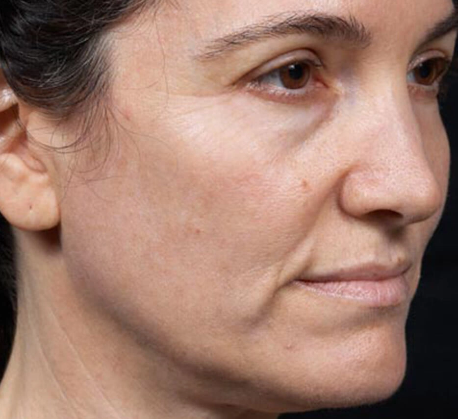 Visage de femme avant un soin de thermage