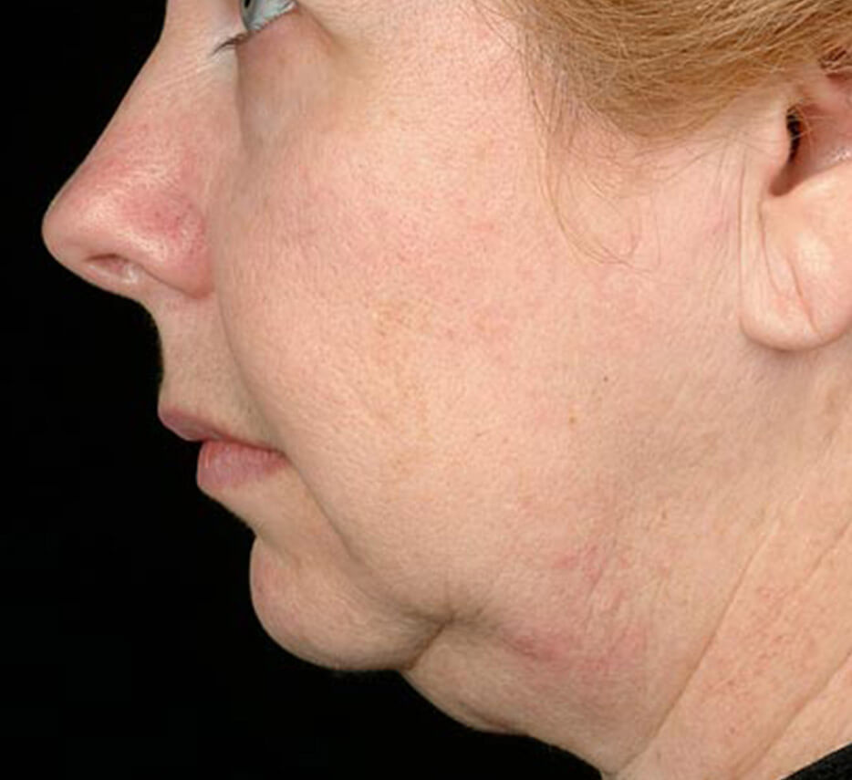Visage de profil avant un soin de thermage