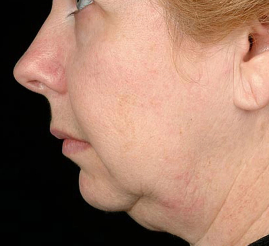 Visage de profil avant un soin de thermage