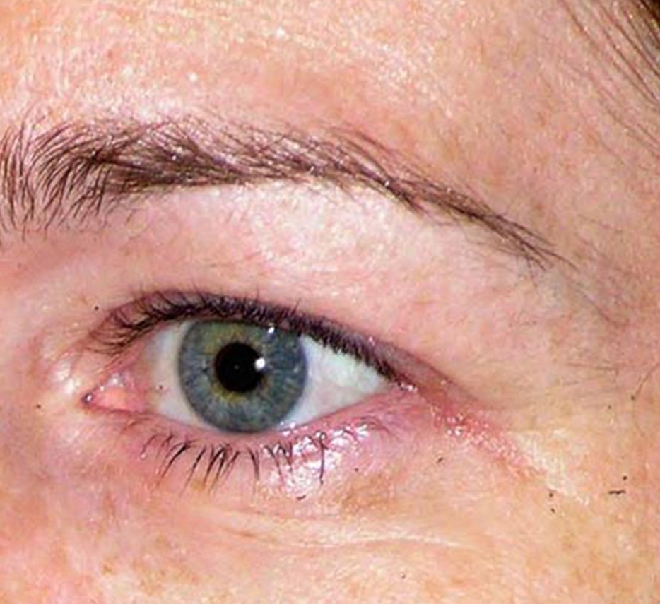 Yeux avant un soin de thermage