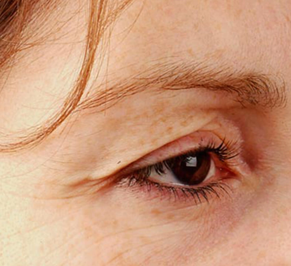 Yeux avant un soin de thermage