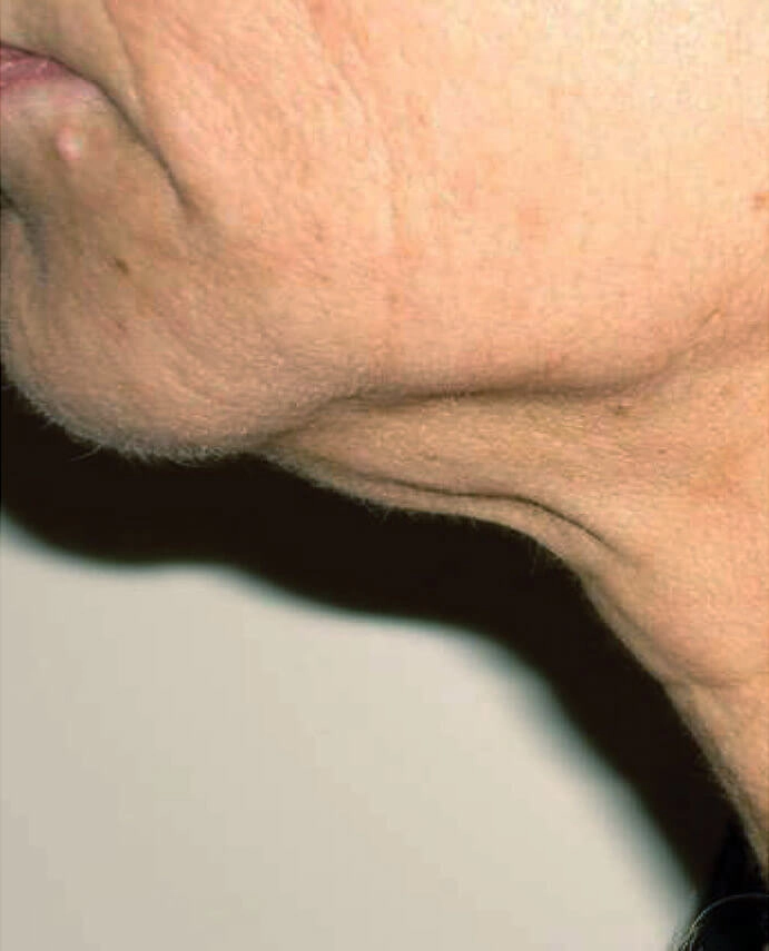 dermapure avant venus freeze 1