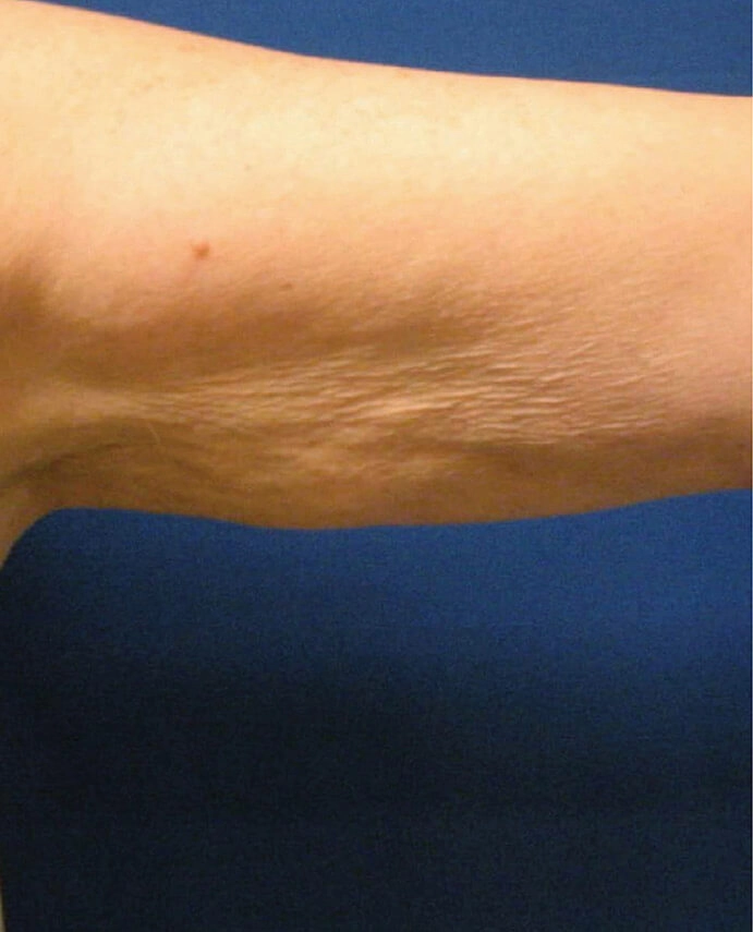 dermapure avant venus freeze 4