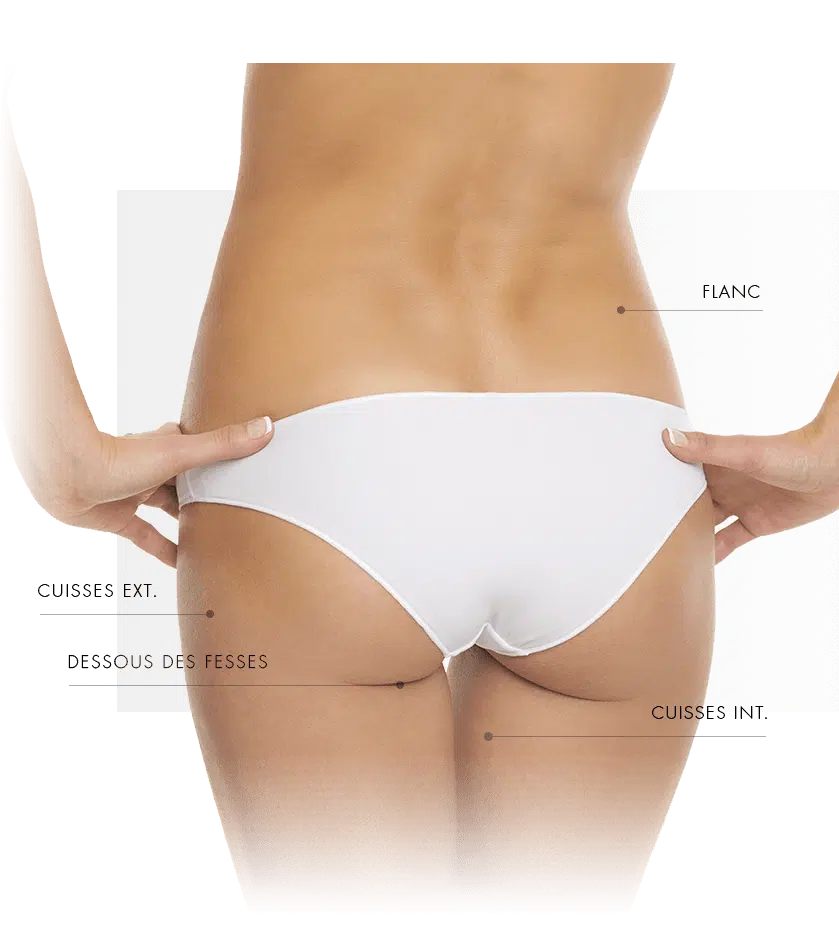 dermapure-coolsculpting zone traites femme