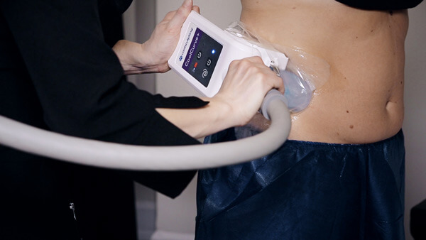 traitement coolsculpting technologie