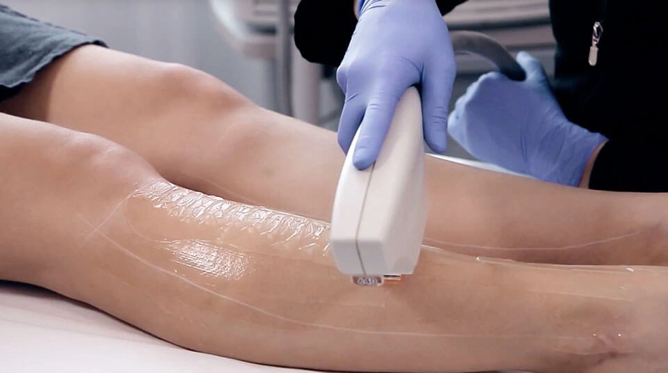 deroulement seance epilation definitive