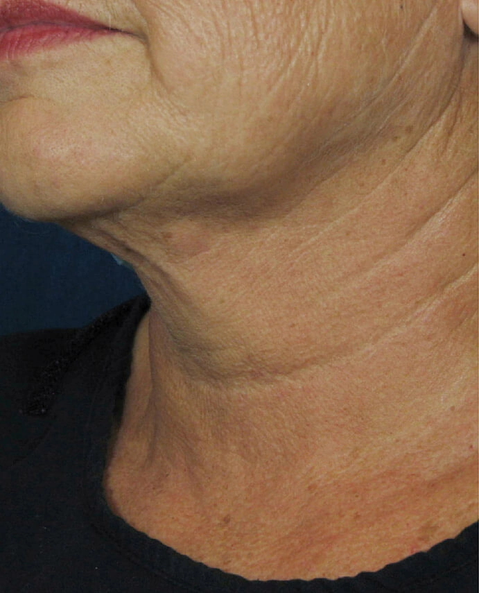 dermapure apres venus freeze 2
