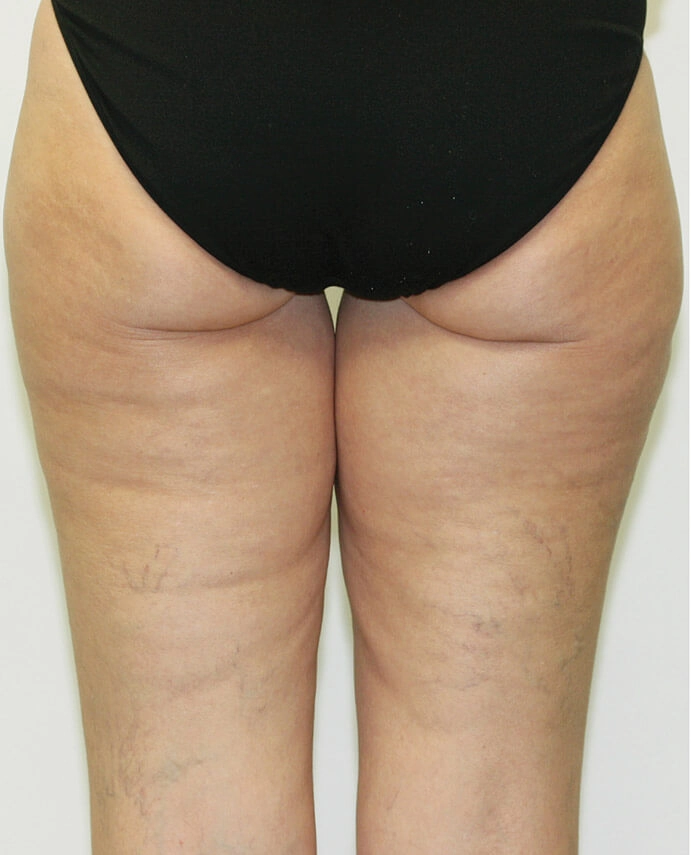 dermapure apresvenus freeze 5
