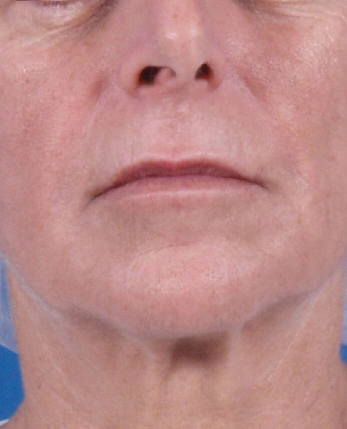 dermapure apres venus freeze 6