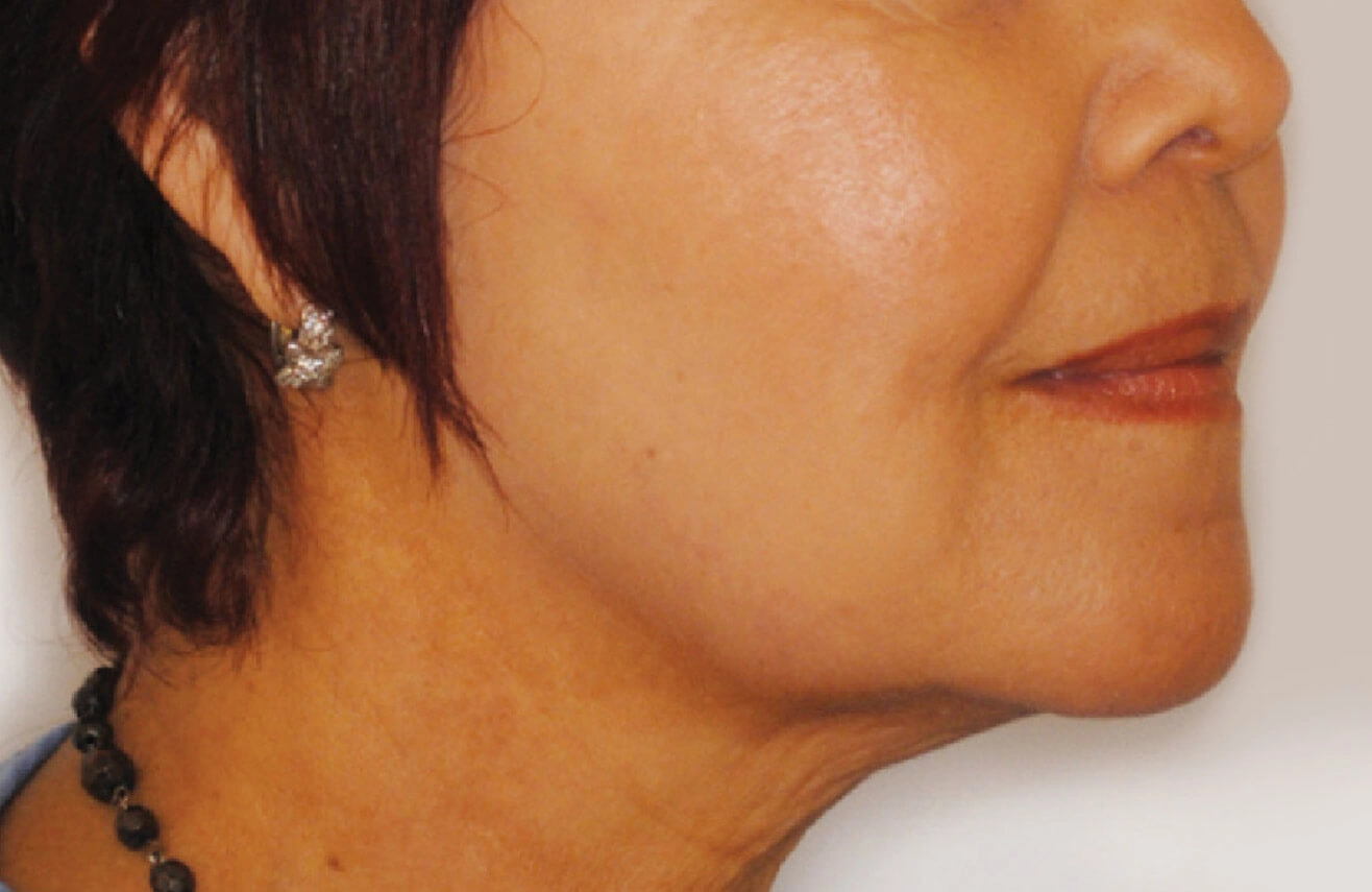 dermapure apres venus freeze 7