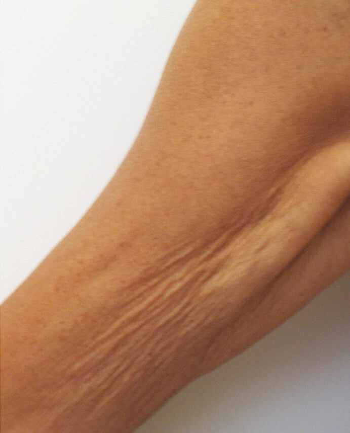 dermapure avant venus freeze 3