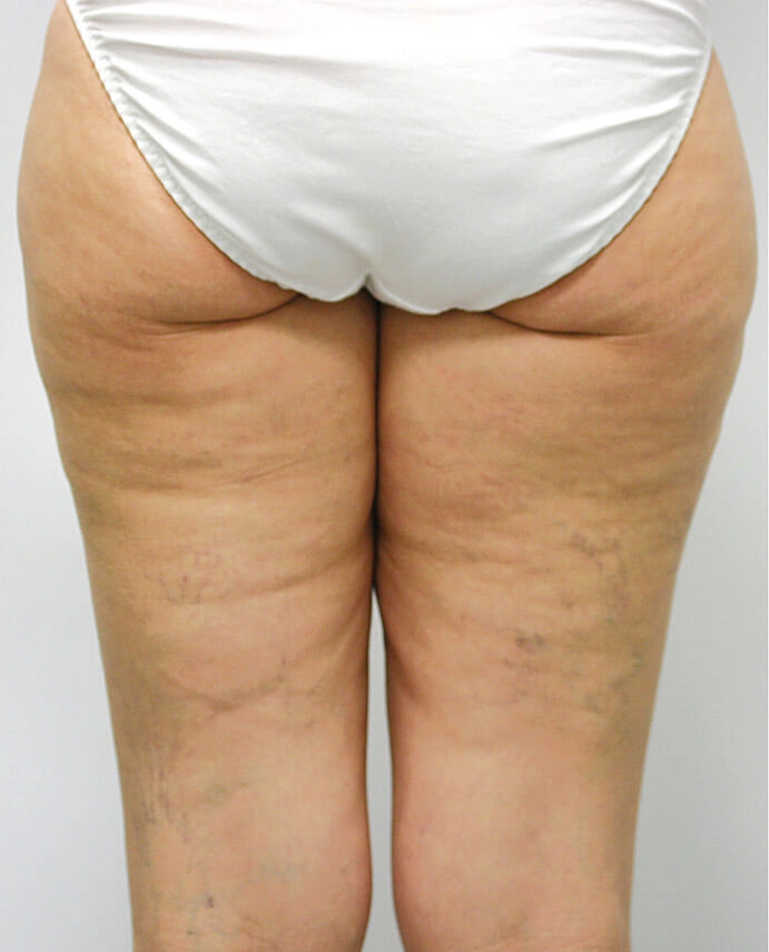 dermapure avant venus freeze 5