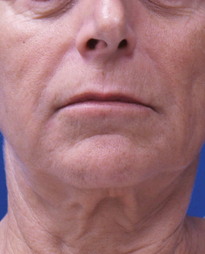 dermapure avant venus freeze 6